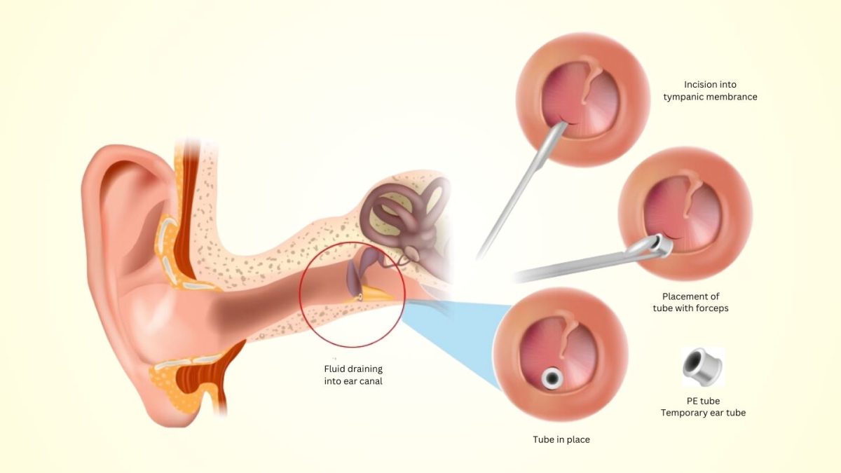 top-things-to-know-about-ear-tube-surgery-for-kids-a-parent-s-guide