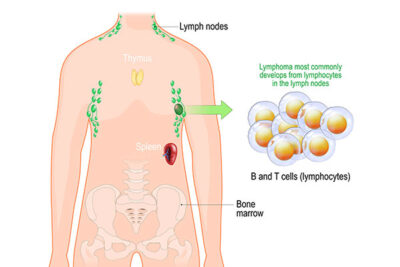 Lymphatic System With Lymph Nodes And T Cells