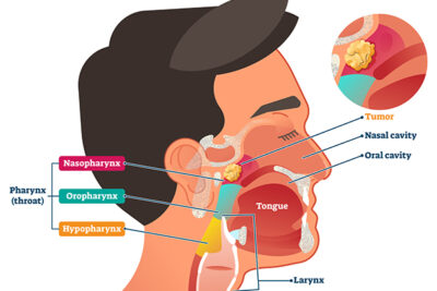 Nasopharyngeal Carcinoma Tumor Diagram